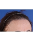 After Hair Transplant&nbsp;Hairline